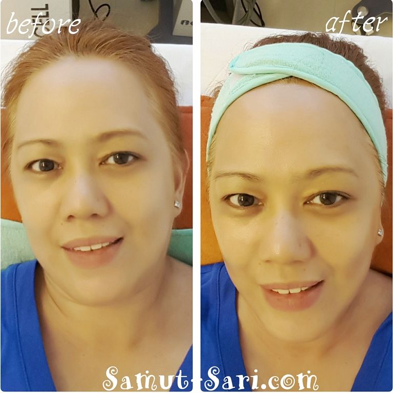Skin Touch Aesthetic & Slimming Center CryoContour Procedure Treatment