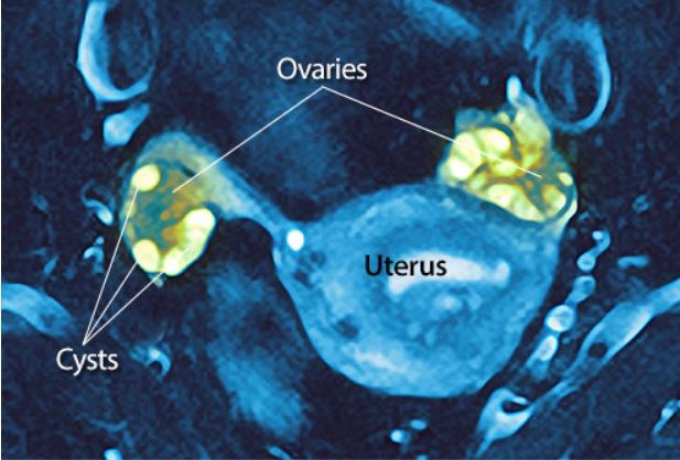 Jeunesse Anion Polycystic Ovary Syndrome