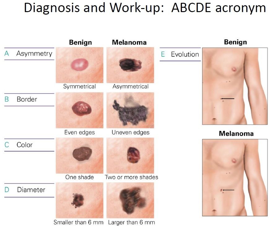 Diagnosis and Work-up of Melanoma
