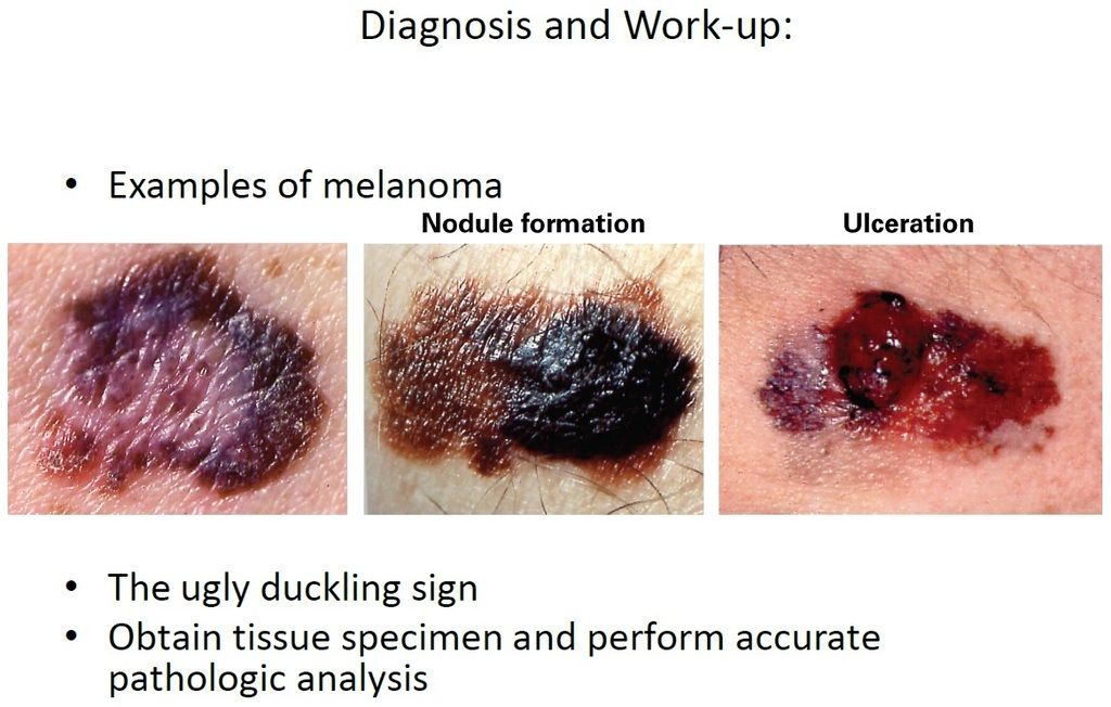 Melanoma Diagnosis and Work up